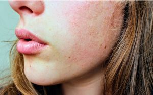 Close up of half a person face with skin irritation on cheeks.
